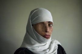 <p>Busha Shari, atacada con ácido por su marido. Islamabad, Pakistán. 2008.</p>