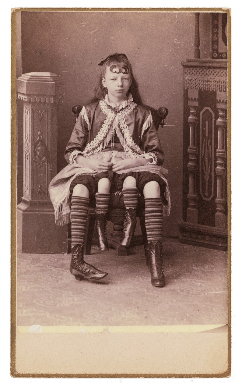 <p>Josephene Myrtle Corbin (1868-1928), artista de circo estadounidense nacida con dípigo. Tenía dos pelvis separadas como resultado de la división del eje de su cuerpo.</p>